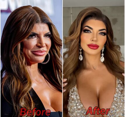 Is it fillers? Joe Giudice's ex-wife Teresa Giudice, 50, looks different on live TV — and now a Beverly Hills expert reveals what she may have had done