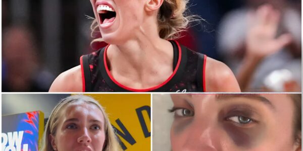 Lexie Hull Shows Incredible Resilience After Head-On Collision, Reveals Battle Scars